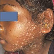 Vesikel pada area sekitar daun telinga (Swain, Santosh & Paul, Roshna. (2021). Herpes Zoster Oticus: A Morbid Clinical Entity. MAMC Journal of Medical Sciences. 7. 10.4103/mamcjms.mamcjms_80_20.)